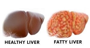 Healthy liver - fatty liver